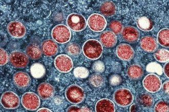 Opicie kiahne na Slovensku Co o nich vieme Takto sa prejavuju siria a tieto skupiny ludi su vo zvysenom riziku